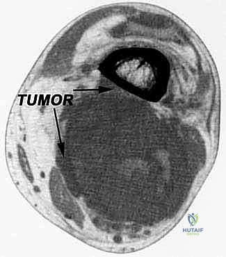 التشريح الدقيق للأعصاب والأوعية الدموية في الحفرة المأبضية