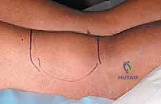 التخطيط الجراحي الدقيق وتحديد مسارات القطع