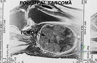 بداية الشق الجراحي الدقيق خلف الركبة