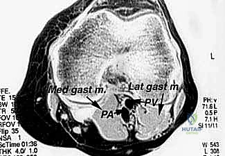 أنواع الأورام والأنسجة المصابة في منطقة الركبة الخلفية