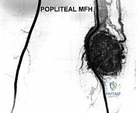 تصوير الرنين المغناطيسي يوضح حجم الورم وامتداده