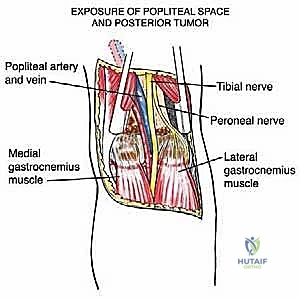 استئصال الورم ككتلة واحدة مع هوامش أمان