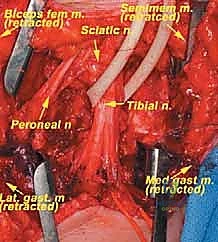 إعادة بناء الأوعية الدموية باستخدام طعم وريدي