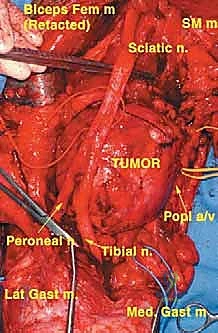 تسليخ وعزل الأعصاب الرئيسية بحذر شديد