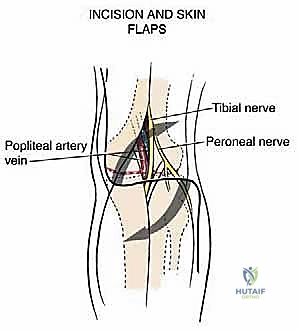 عزل الشريان والوريد المأبضي عن الكتلة الورمية