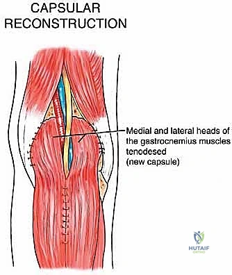 استئصال أورام الحفرة المأبضية مع الحفاظ على الأطراف: دليل شامل للمرضى مع الأستاذ الدكتور محمد هطيف