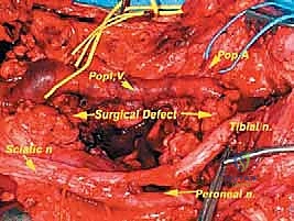 تغطية الجرح وإعادة بناء الأنسجة باستخدام السدائل العضلية