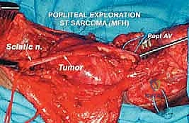 الورم المستأصل وإرساله للفحص الباثولوجي الدقيق