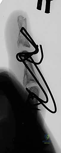 Dynamic External Fixation of PIP Joint Fracture-Dislocations: An Intraoperative Masterclass