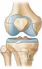 صورة توضح وضع الصفيحة والمسامير بدقة