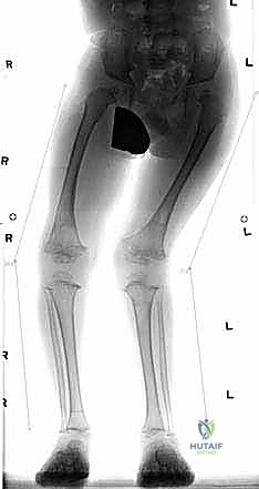 صورة توضيحية للتقييم الإشعاعي وتحديد زوايا التشوه