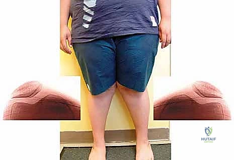 صورة توضح حالة صبي يبلغ من العمر 13 عامًا يعاني من السمنة والركبة الروحاء مجهولة السبب مع زيادة المسافة بين الكاحلين وعدم استقرار الرضفة.