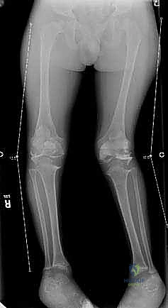 صورة توضيحية لـ نمو العظام الموجه لتصحيح تشوهات الأطراف: حل مبتكر للأطفال والمراهقين
