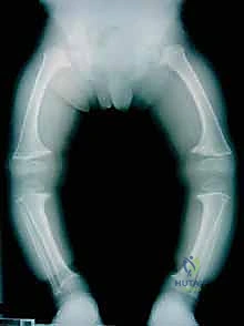 صورة توضح الانحراف التدريجي للمحور الميكانيكي للساق، مؤكدة حتمية التدخل الجراحي.