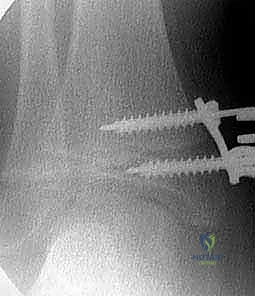 صورة توضيحية لـ نمو العظام الموجه لتصحيح تشوهات الأطراف: حل مبتكر للأطفال والمراهقين