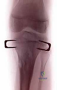 صورة إشعاعية توضح تثبيت الصفيحة على شكل رقم 8