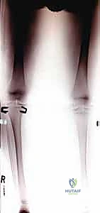 صورة توضيحية لسبب من أسباب تشوهات الأطراف السفلية