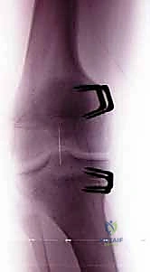 صورة توضيحية لـ نمو العظام الموجه لتصحيح تشوهات الأطراف: حل مبتكر للأطفال والمراهقين