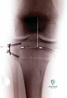 Guided Growth for Limb Deformity: An Intraoperative Masterclass in Physeal Modulation