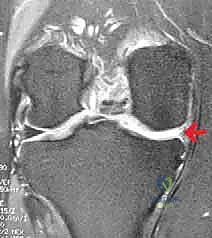 صورة توضيحية لـ زراعة الغضروف الهلالي: استعادة وظيفة الركبة وحماية المفصل