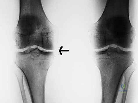 التمزقات التنكسية في الركبة