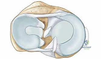 Meniscal Allograft Transplantation: A Masterclass in Restorative Knee Surgery