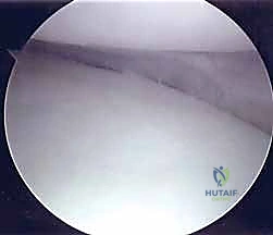 تدهور المفصل بعد الاستئصال