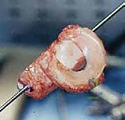 ميكانيكا الركبة والضغوط على الغضروف