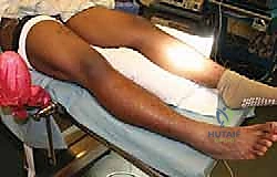 التنظير المفصلي الدقيق بواسطة الدكتور هطيف