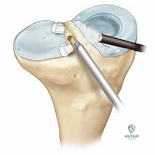 صورة طبية: زراعة الغضروف الهلالي: استعادة وظيفة الركبة وحماية المفصل
