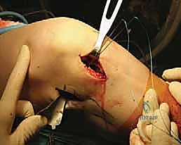 طعم الغضروف الهلالي قبل الزراعة