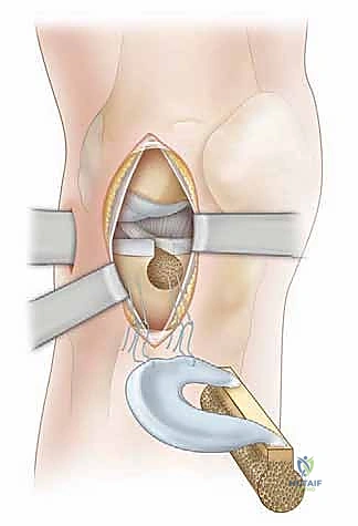 صورة توضيحية لـ زراعة الغضروف الهلالي: استعادة وظيفة الركبة وحماية المفصل
