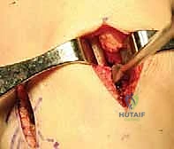 تجهيز الطعم العظمي على الطاولة الجانبية