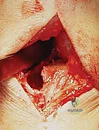 صورة طبية: زراعة الغضروف الهلالي: استعادة وظيفة الركبة وحماية المفصل