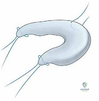 صورة طبية: زراعة الغضروف الهلالي: استعادة وظيفة الركبة وحماية المفصل