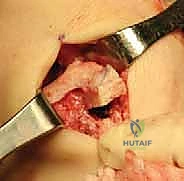 صورة طبية: زراعة الغضروف الهلالي: استعادة وظيفة الركبة وحماية المفصل