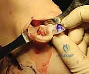 صورة توضيحية لـ زراعة الغضروف الهلالي: استعادة وظيفة الركبة وحماية المفصل