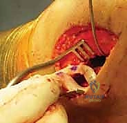 حفر الأنفاق العظمية بالمنظار