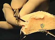 صورة توضيحية لـ زراعة الغضروف الهلالي: استعادة وظيفة الركبة وحماية المفصل