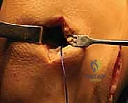 أدوات قياس حجم الغضروف