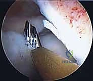 تثبيت الطعم داخل النفق