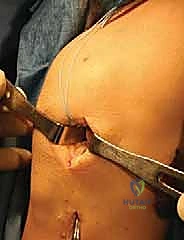 صورة طبية: زراعة الغضروف الهلالي: استعادة وظيفة الركبة وحماية المفصل