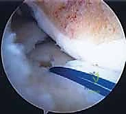 استخدام الخيوط الجراحية في الطعم