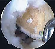 إدخال الطعم إلى الركبة