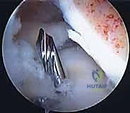 صورة توضيحية لـ زراعة الغضروف الهلالي: استعادة وظيفة الركبة وحماية المفصل