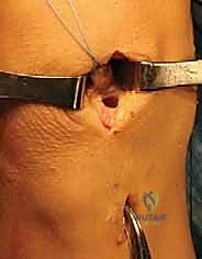 صورة توضيحية لـ زراعة الغضروف الهلالي: استعادة وظيفة الركبة وحماية المفصل