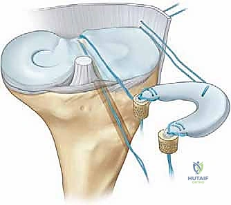 صورة توضيحية لـ زراعة الغضروف الهلالي: استعادة وظيفة الركبة وحماية المفصل
