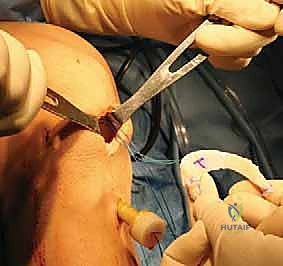 صورة طبية: زراعة الغضروف الهلالي: استعادة وظيفة الركبة وحماية المفصل