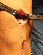 التنظير التشخيصي للركبة