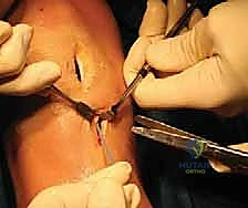 صورة طبية: زراعة الغضروف الهلالي: استعادة وظيفة الركبة وحماية المفصل